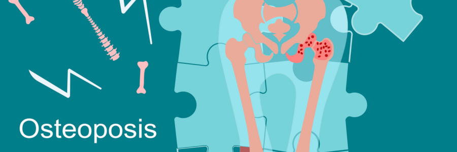 Read more about the article Top 5 Actions to Take When Diagnosed with Osteoporosis